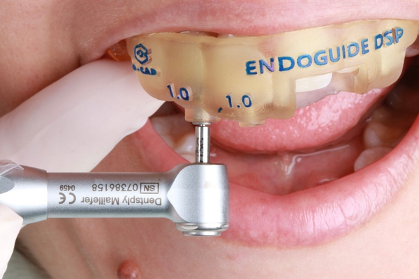Endo Access