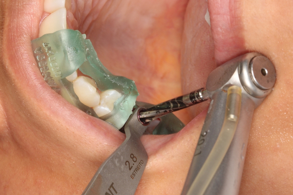 Cirurgia Guiada de Implantes